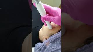 RADIOFREQUÊNCIA FRACIONADA MICROAGULHADA PARA TRATAR CICATRIZ DE ACNE [upl. by Koch]