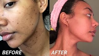 HOW TO GET RID OF DARK SPOTS amp HYPERPIGMENTATION FAST [upl. by Thaddus]