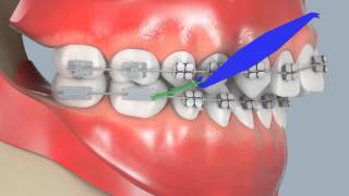 How to put on Class II Elastics [upl. by Gulick]