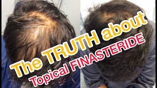 Topical Finasteride  Minoxidil results after 6 Months [upl. by Maier67]