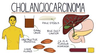 Understanding Cholangiocarcinoma [upl. by Alleyne]