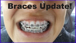 BRACES UPDATE 1 [upl. by Halyak608]