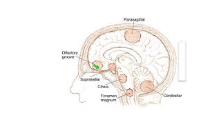 Meningiomas Signs Symptoms and Advanced Treatment Options [upl. by Elleiand234]