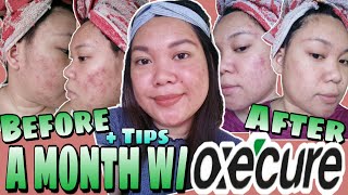 MY SKIN UPDATE AFTER A MONTH W OXECURE  TIPS ON HOW TO GET quotCLEAR SKINquot  SARRAH ROBITE [upl. by Asseret403]