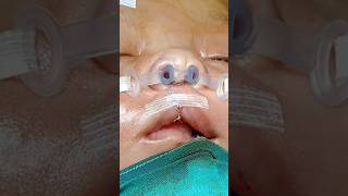 Cleft Lip and Nose Repair  How It Looks Immediate After Surgery  Dr Parit Ladani [upl. by Crispa]