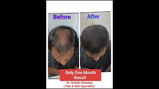 सिर्फ़ एक महीने में बालों की इतनी अच्छी Regrowth wow 😲😲। hairloss HairFall baldness transplant [upl. by Clevey]