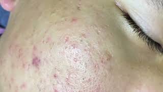 Blackheads amp Whiteheads Removal New 2024 Acne Treatment With Nhat Bang [upl. by Arjun352]