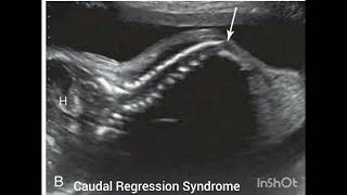 Ultrasound of Caudal Regression Syndrome Review from the book Requisites [upl. by Durwin]