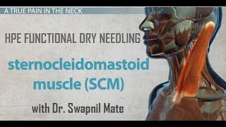 Dry Needling for Sternocleido Mastoid Muscle [upl. by Antonino]