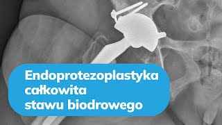 Endoprotezoplastyka całkowita stawu biodrowego  dr hab n med Ireneusz Babiak [upl. by Rett804]