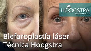 😊¿Cuándo se ve el RESULTADO final de una BLEFAROPLASTIA💯  21167 [upl. by Fotzsyzrk587]