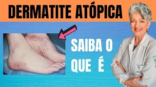 DERMATITE ATÓPICA Saiba O Que é E Como Tratar [upl. by Eneres683]