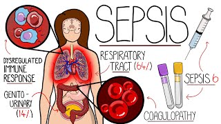 Understanding Sepsis Sepsis Explained Clearly [upl. by Hcir236]