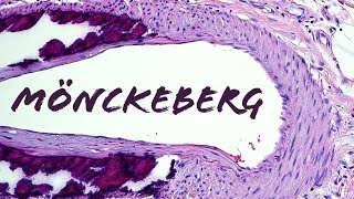 Monckeberg medial calcific sclerosis blood vessel calcification  NOT calciphylaxis pathology [upl. by Oicnedurp]