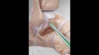 Ankle ligaments repair  animationshorts shortsfeed youtubeshorts viralshorts [upl. by Dunton]