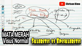 Mata Merah Visus Normal Skleritis vs Episkleritis Skleritis Difusa Nodusa Necroticans Perforans [upl. by Sajet]