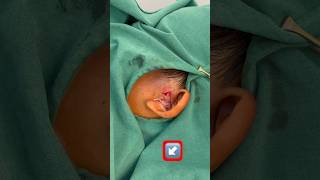 preauricular sinus abscess shorts abcess [upl. by Egiap202]