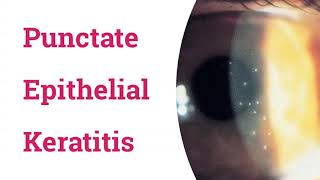 Punctate Epithelial Keratitis PEK [upl. by Gratianna]