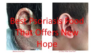 EnerFlex Nutrition  Case Studies on Scalp Plaque and Erythrodermic Psoriasis Updated 42016 [upl. by Harold]