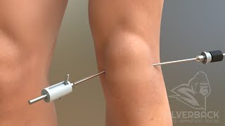 Knee Arthroscopy Animated Video [upl. by Euqinahc]