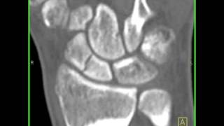 Wrist Anatomy Nonunion of a scaphoid fracture 3 of 3 [upl. by Aliemaj]