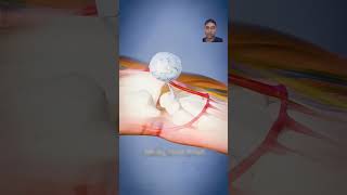 Tumor operation art motivation experiment trending tümör viralvideo shorts foryou inversion [upl. by Ailekahs]