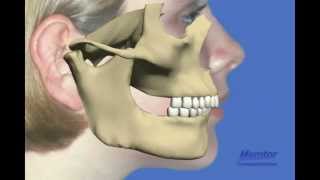 Herbst appliancemove lower jaw forward [upl. by Nauwaj]