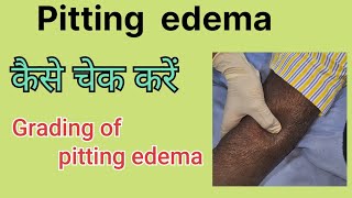 Pitting edema How to examine pitting edema Grades in pitting edema [upl. by Enyaht]