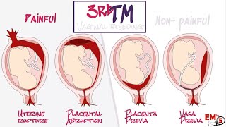 APH Antepartum haemorrhage [upl. by Annoel997]