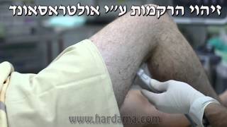 חסם עצבי סכיאטי פופליטאלי Sciatic popliteal block [upl. by Dalenna]