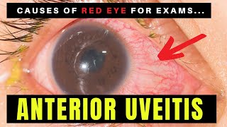 Causes of Red Eye  Part 2 ANTERIOR UVEITIS Iritis [upl. by Giarla372]