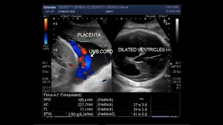 Ultrasound Video showing Cephalopelvic disproportion due to Hydrocephalus [upl. by Atnuahsal]