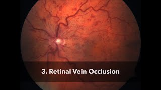 3 Retinal Vein Occlusion [upl. by Nutter]