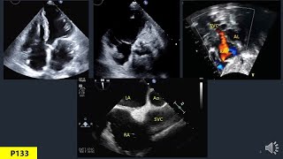 Anatomy Of Heart In Echo Part 6 Right Atrium [upl. by Yrffoeg]