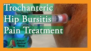 Trochanteric Hip Bursitis Pain Treatment  Auburn Medical Group [upl. by Brannon]