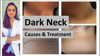 dark neck  causes treatment  Home remedies  Dermatologist Dr Aanchal Panth [upl. by Eeimaj]