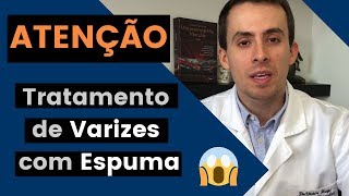 Tratamento de Varizes com Espuma NÃO faça antes de ver esse vídeo [upl. by Korns]