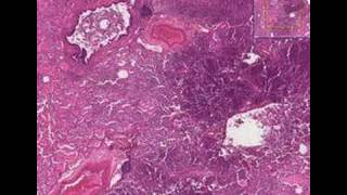 Histopathology Lung Bronchopneumonia with microabscesses [upl. by Endres655]