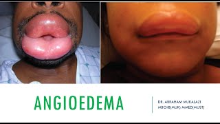 ANGOEDEMA BY DR ABRAHAM dermatology lecture dermatology viralvideo [upl. by Alegre]