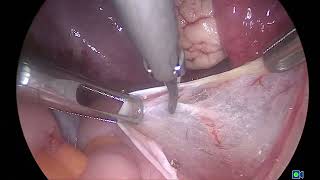 Lap excision of incidentally found deep endometriosis in a patient with mucinous ovarian cyst [upl. by Vivl216]