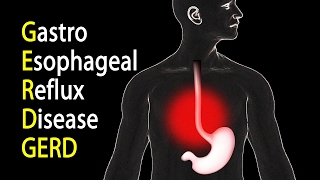 Gastro Esophageal Reflux Disease Update Vlog Style [upl. by Llenart602]