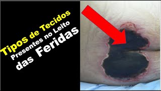 CURATIVOS Tipos de Tecidos Presentes no Leito das Feridas [upl. by Emmi346]