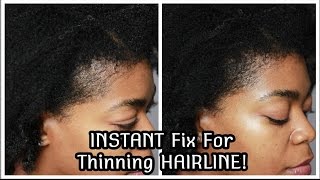 INSTANT Fix For Thinning HairlineEdges Anemia Hair loss Balding Postpartum Toppik  4C Hair [upl. by Amadas]