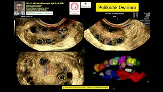 Ovarium Polikistik [upl. by Rramo]