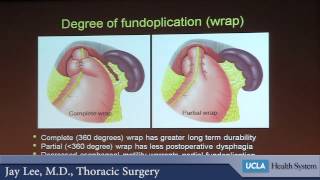 Surgery and the Esophagus  What does minimally invasive mean  Dr Jay Moon Le [upl. by Vaclav]