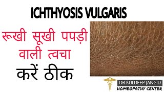 Best treatment of ichthyosis । Treatment of dry skin । Treatment of cracks in skin ।रूखी त्वचा । [upl. by Kenji]