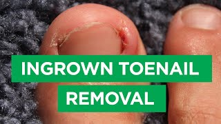 Ep 59 Ingrown Toenail Removal Procedure  The Scope [upl. by Lundin]