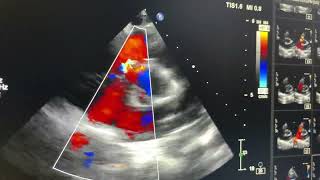 Gerbode defect isolated [upl. by Sabella]