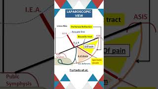 Triangle of pain in Inguinal hernia surgicaleducation biology conceptualsurgery [upl. by Westley328]