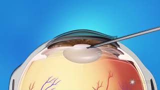 What is eye drop Cataract surgery  Dr Samina F Zamindar [upl. by Yazbak]